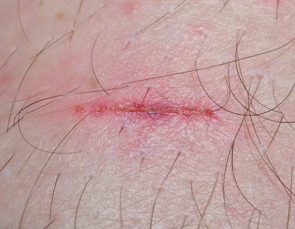 wound-321361.jpg
