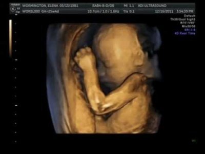 "Dört Boyutlu Çekilen Ultrasonda Anne Karnındaki Bebek Esnerken Görüntülendi" Hakkında diğer bilgiler